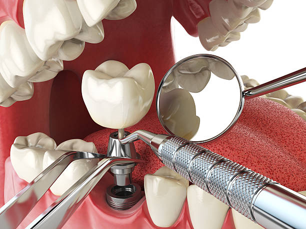 Best Emergency Root Canal Treatment in Naples, FL